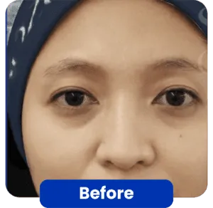 filler treatment before-after