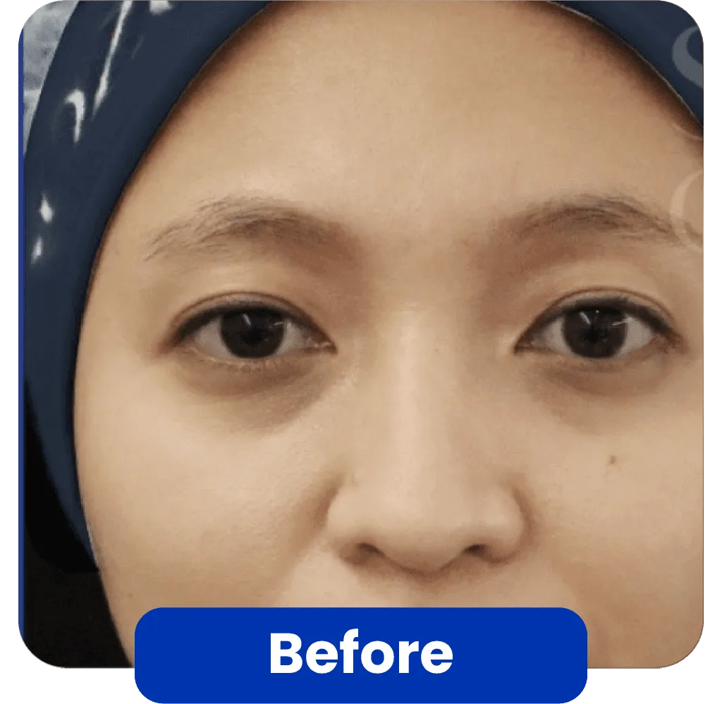 filler treatment before-after
