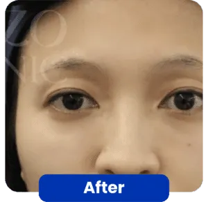 filler treatment before-after