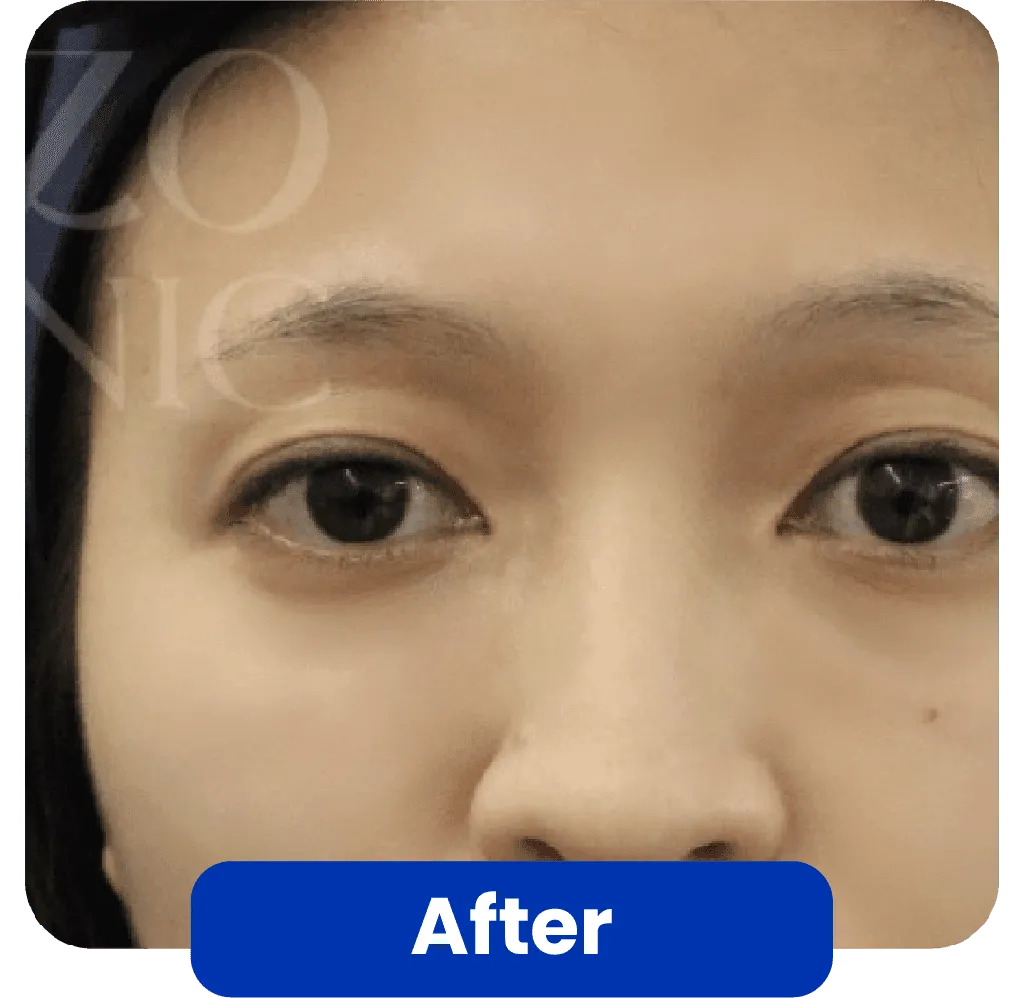 filler treatment before-after