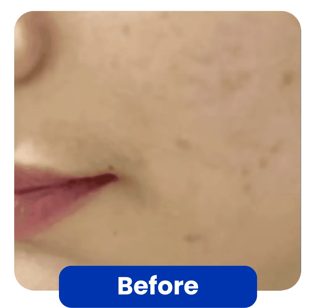 Kondisi Kulit Sebelum Skin Booster Treatment