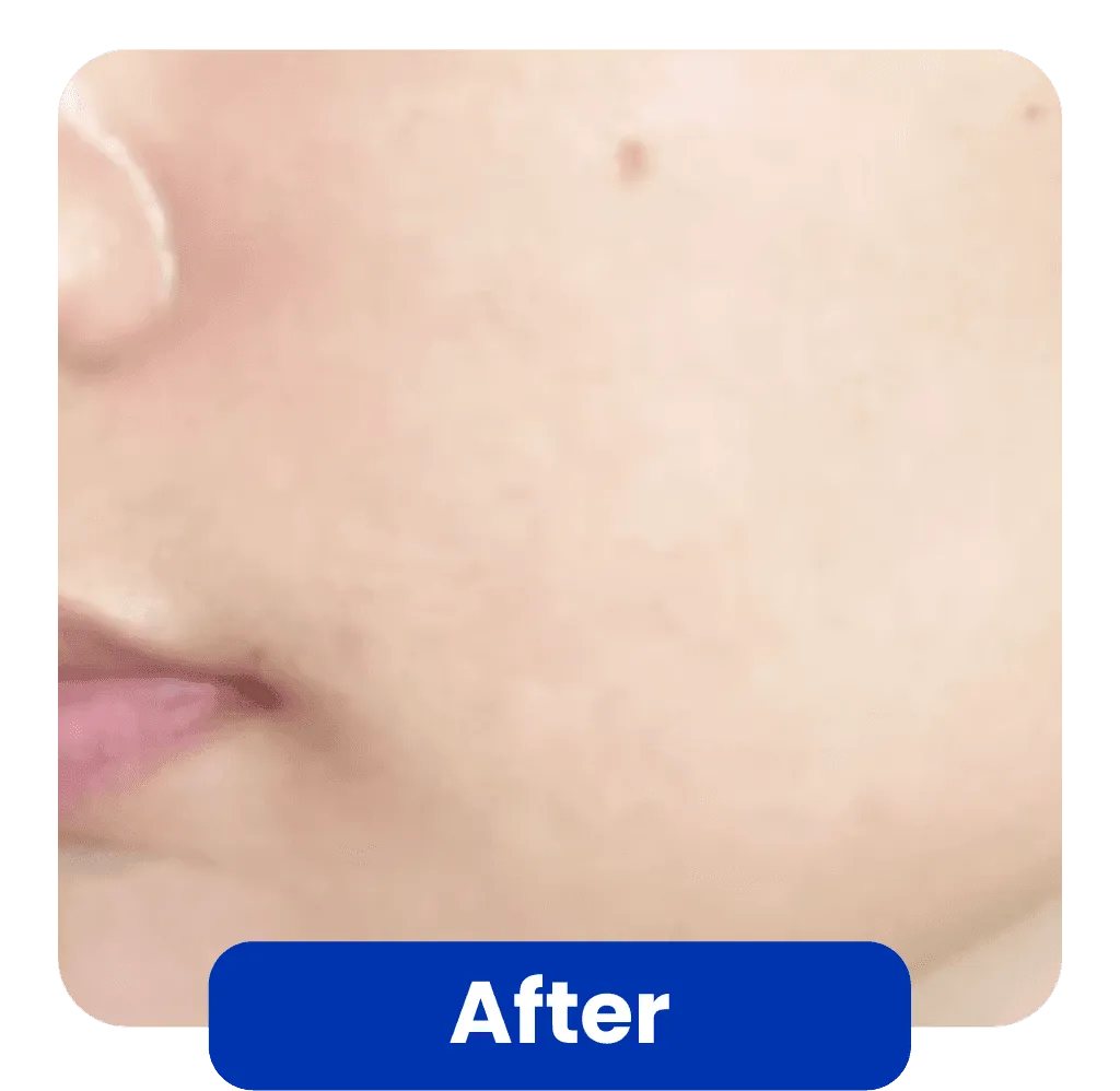 Kondisi Kulit Setelah Skin Booster Treatment