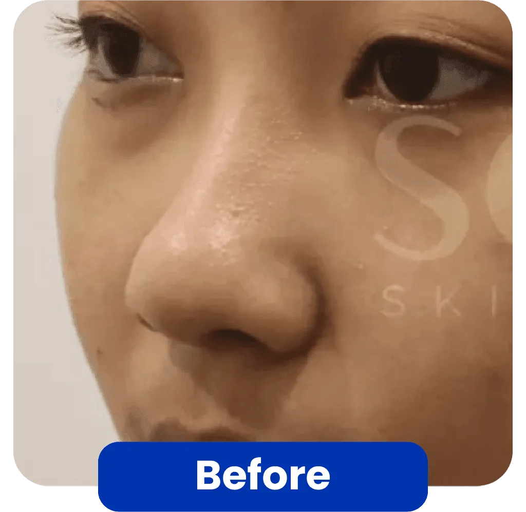Before Threadlift