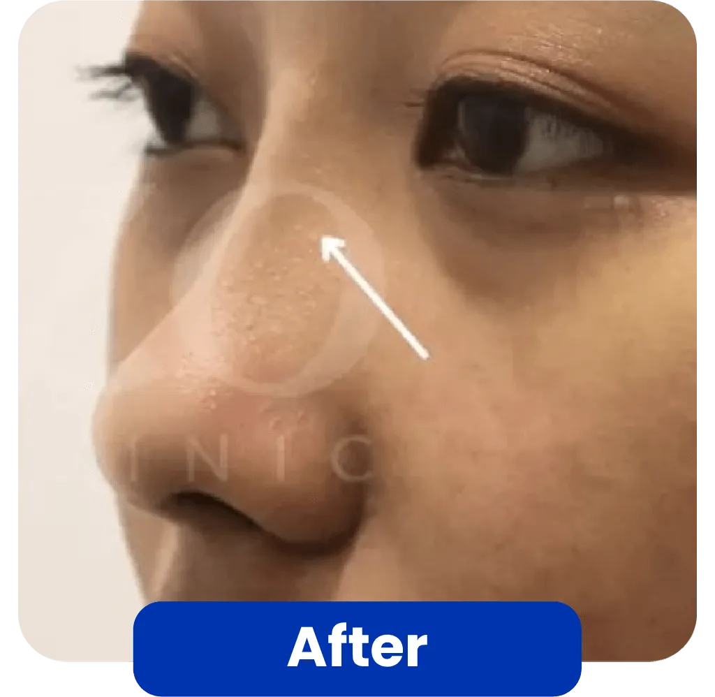 After Threadlift
