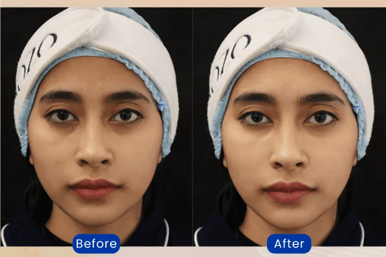 before after infus whitening