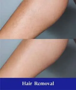 before after hair removal treatment sozo skin clinic