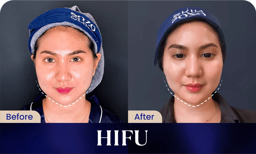 Before After HIFU Treatment 2