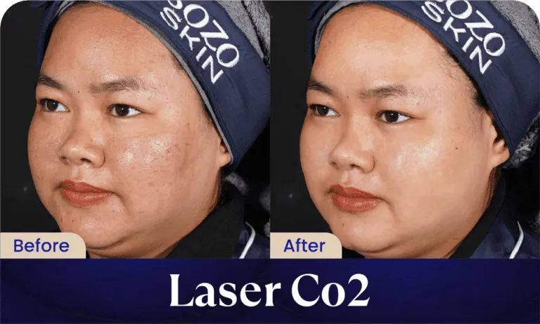 before after laser co2 treatment - klinik kecantikan sozo skin clinic