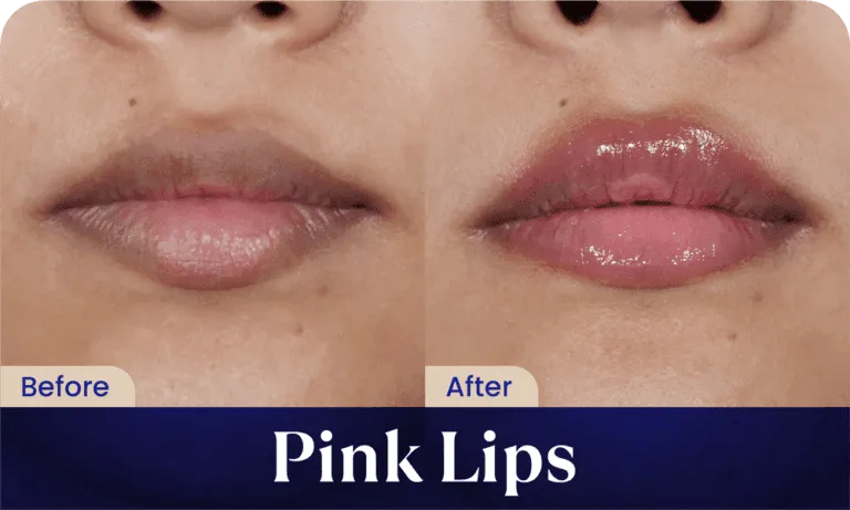 before after pink lips treatment - klinik kecantikan sozo skin clinic