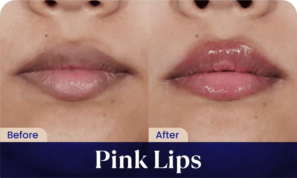 before after pink lips treatment - klinik kecantikan sozo skin clinic