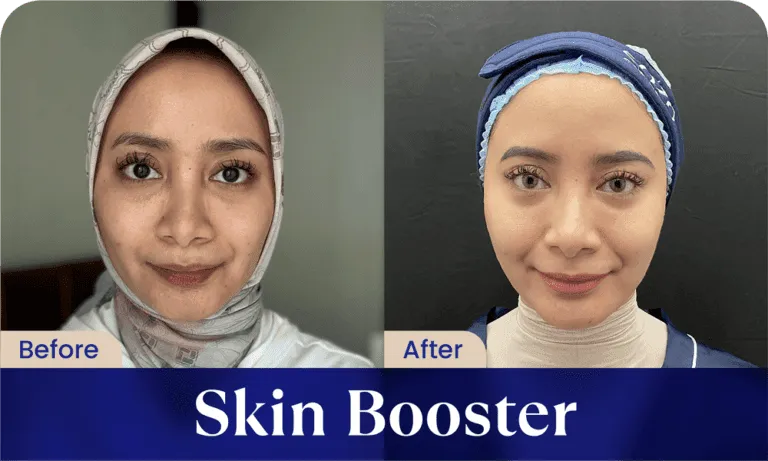 before after skin booster treatment - klinik kecantikan sozo skin clinic