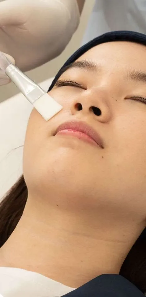glow peel - sozo skin clinic - derma peel treatment