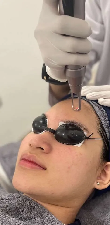 nano laser - sozo skin clinic