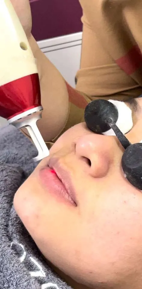 laser treatment - pink lips sozo skin clinic