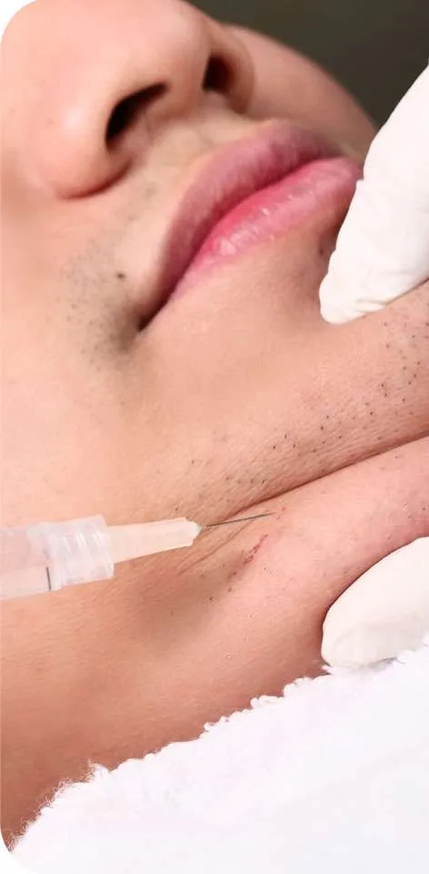 meso slimming - face - sozo skin clinic