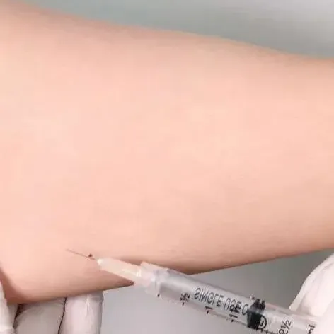 meso treatment SOZO