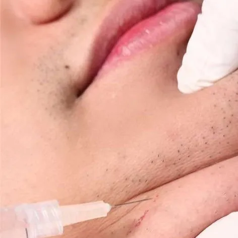 Meso Treatment