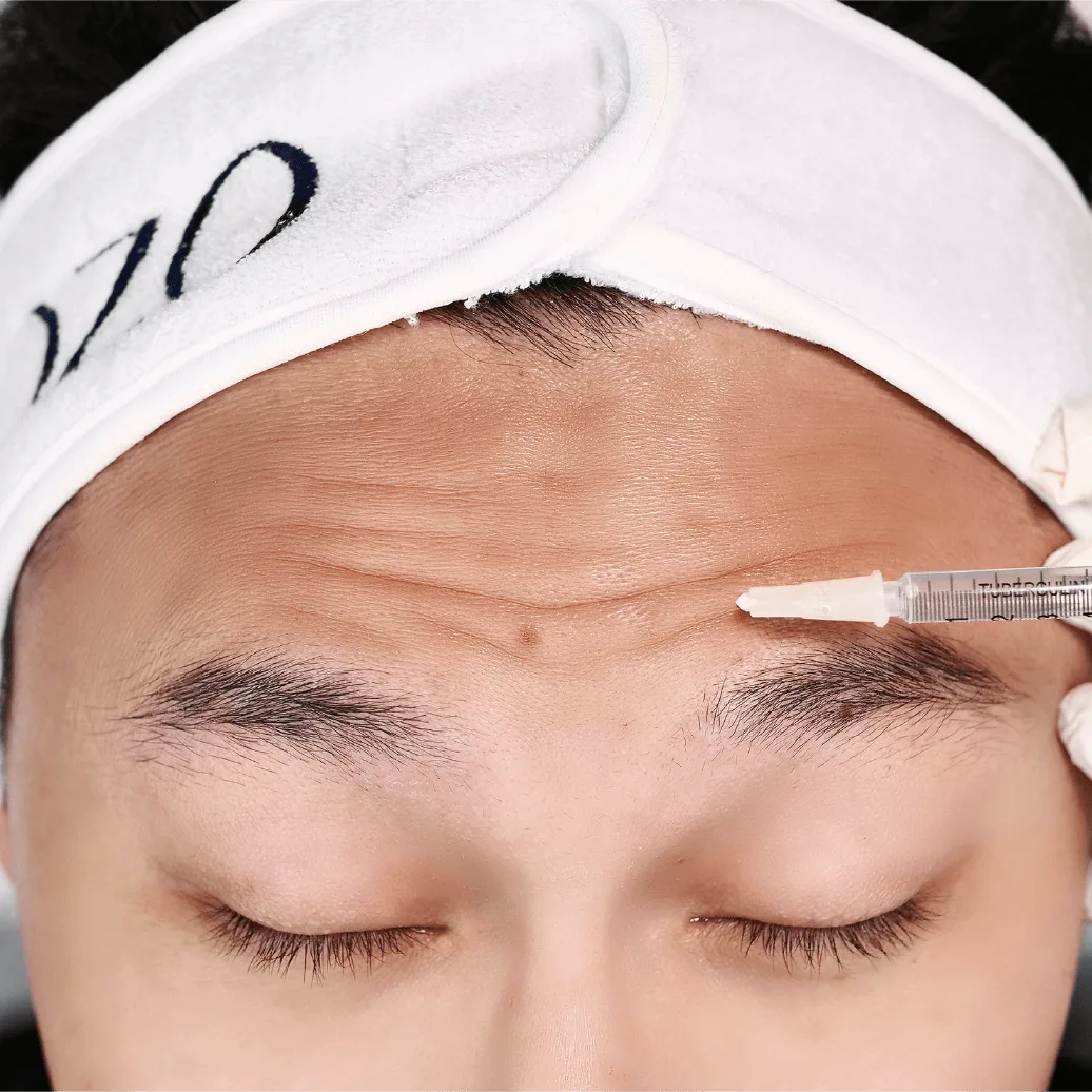 Zo-tox Treatment