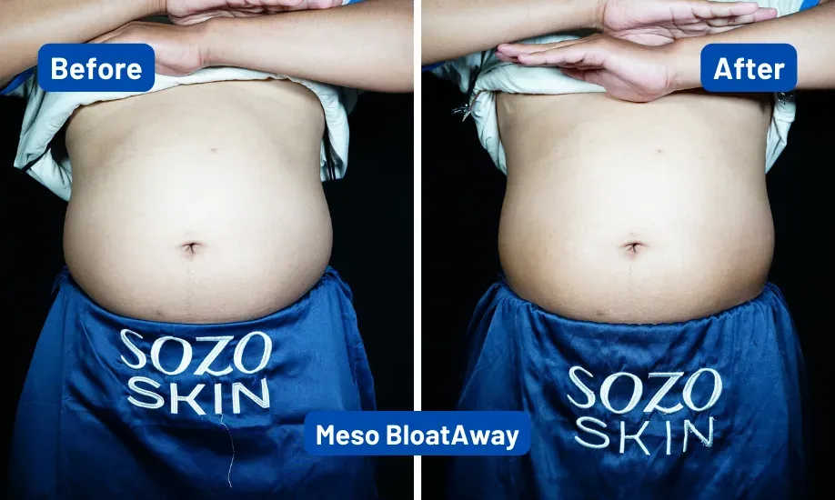Before After Meso Slimming 3