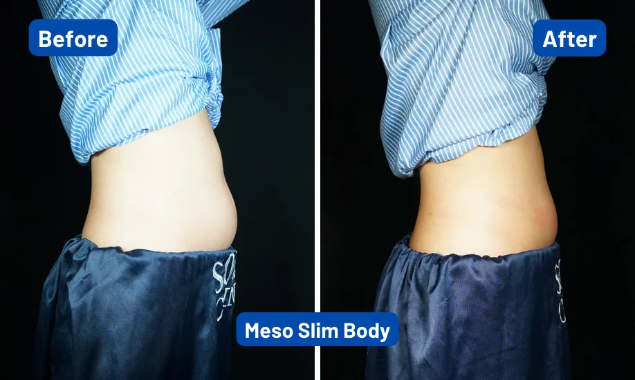 Before After Meso Slimming 2