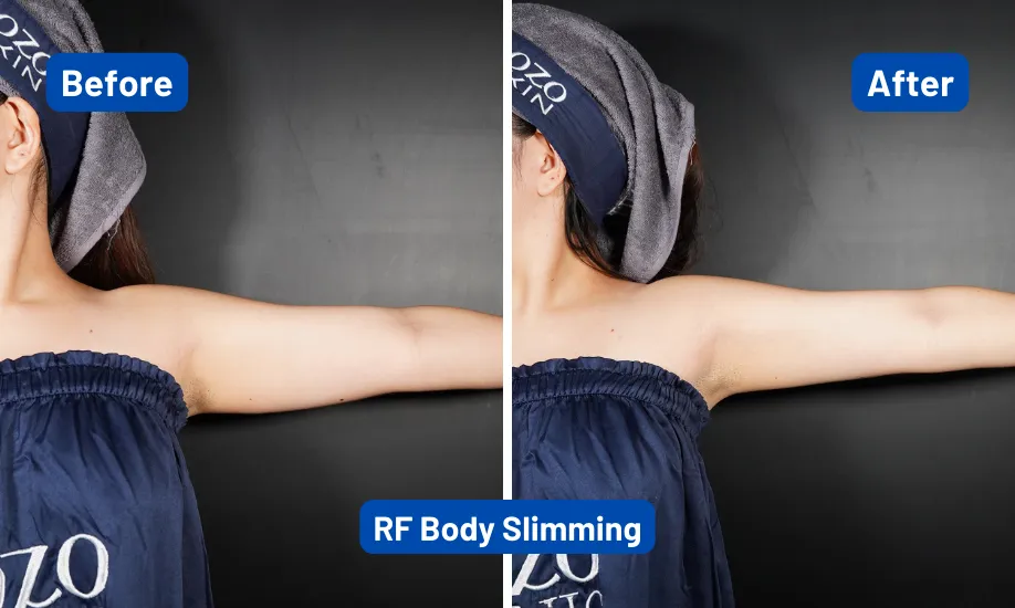 Before After Radiofrequency 2