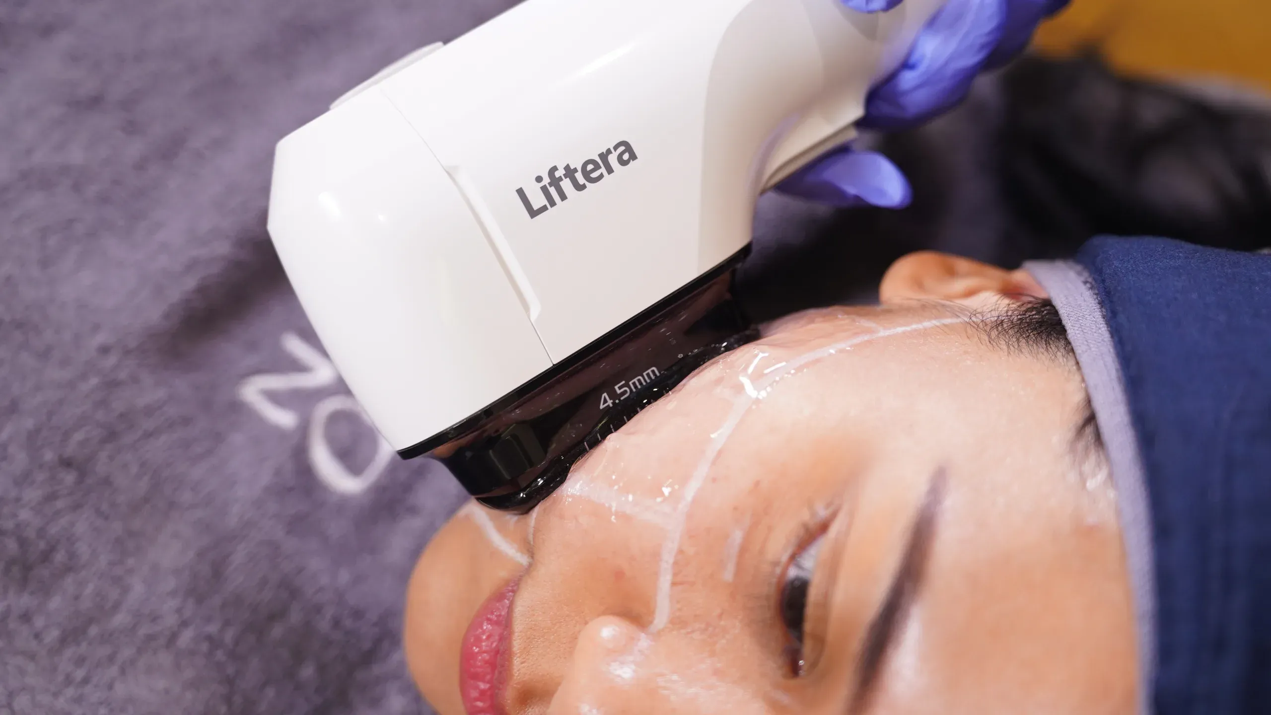 Hifu Treatment Sozo 3
