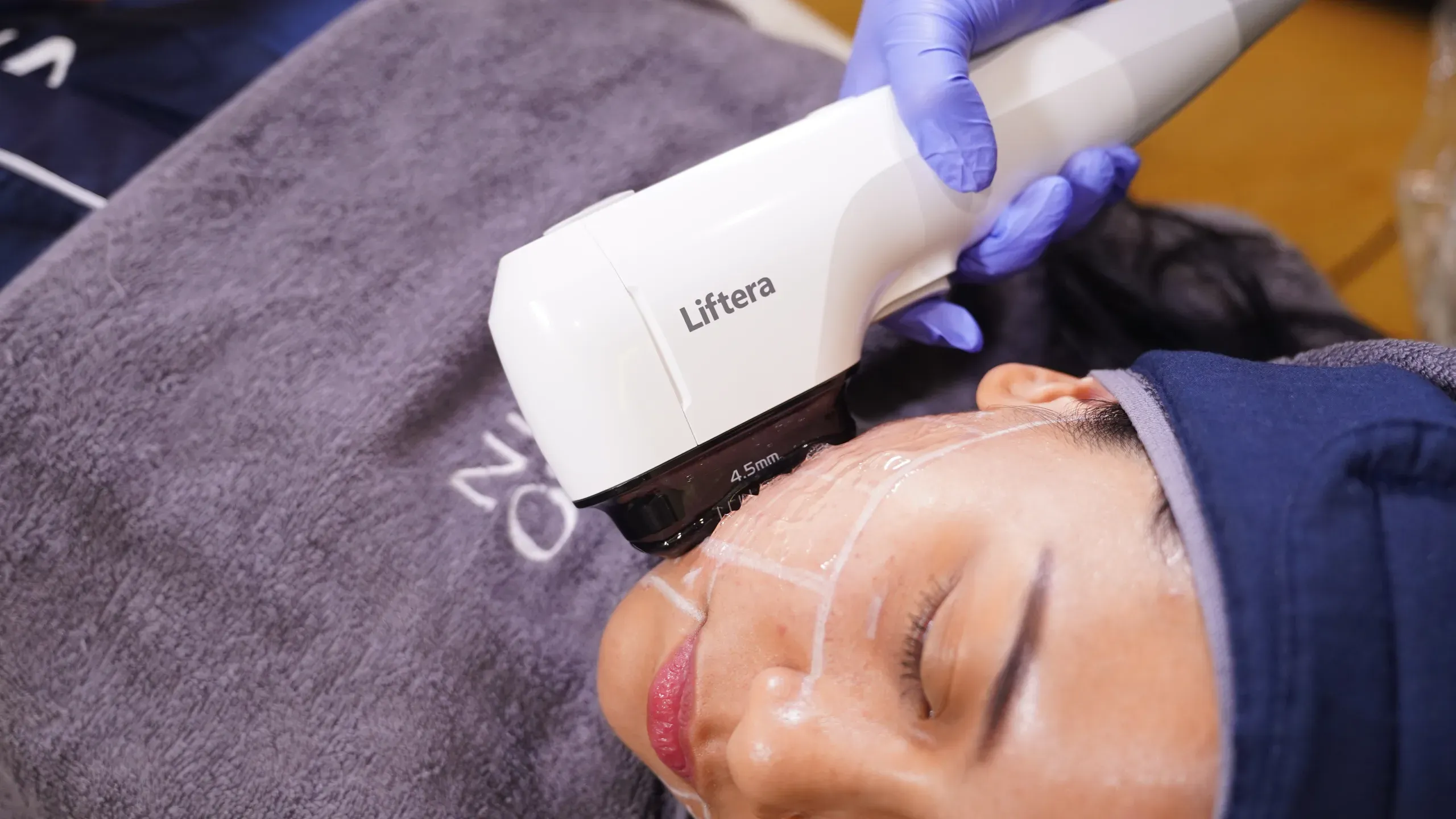 Hifu Treatment Sozo 1