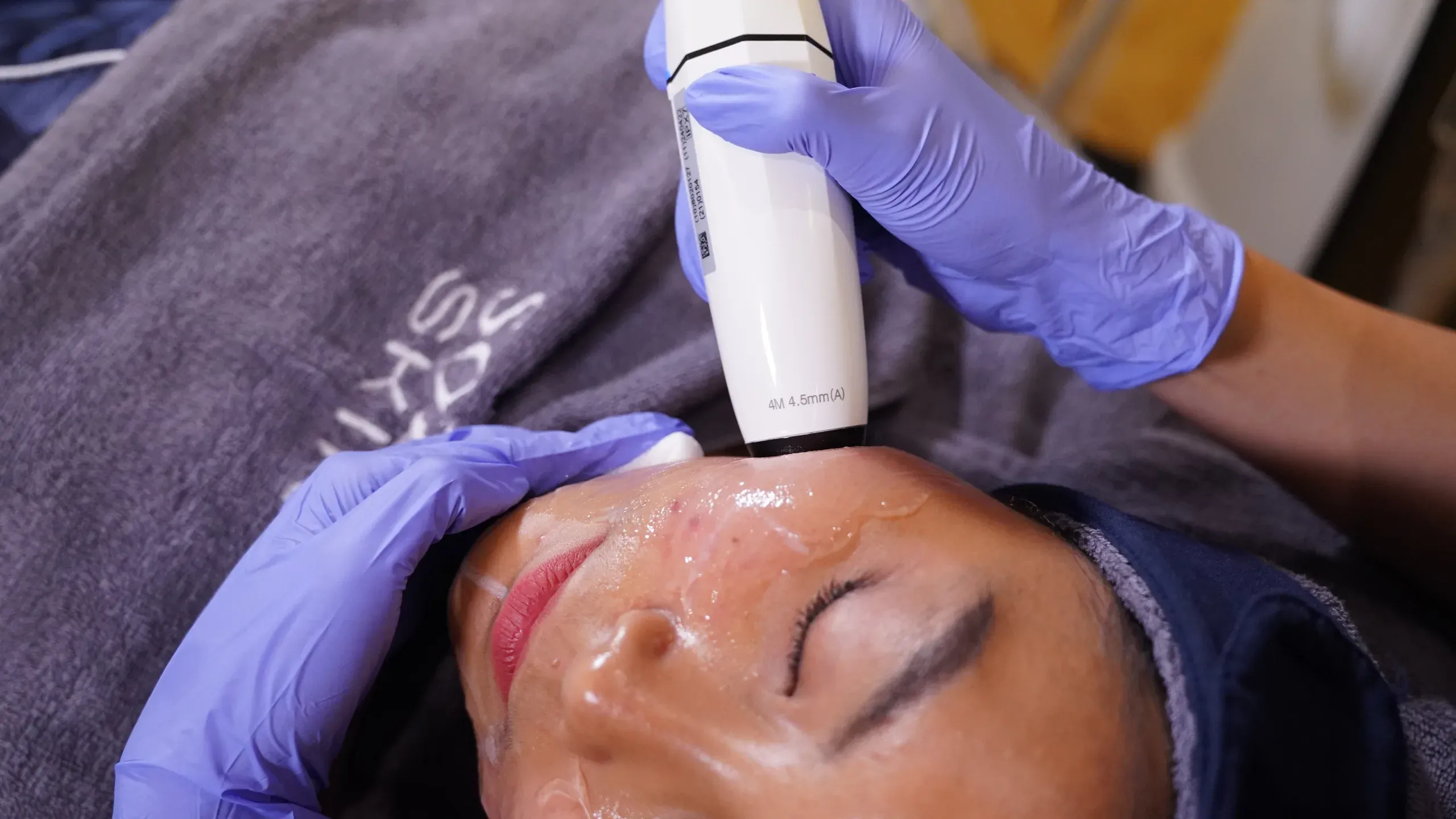 Hifu Treatment Sozo 4
