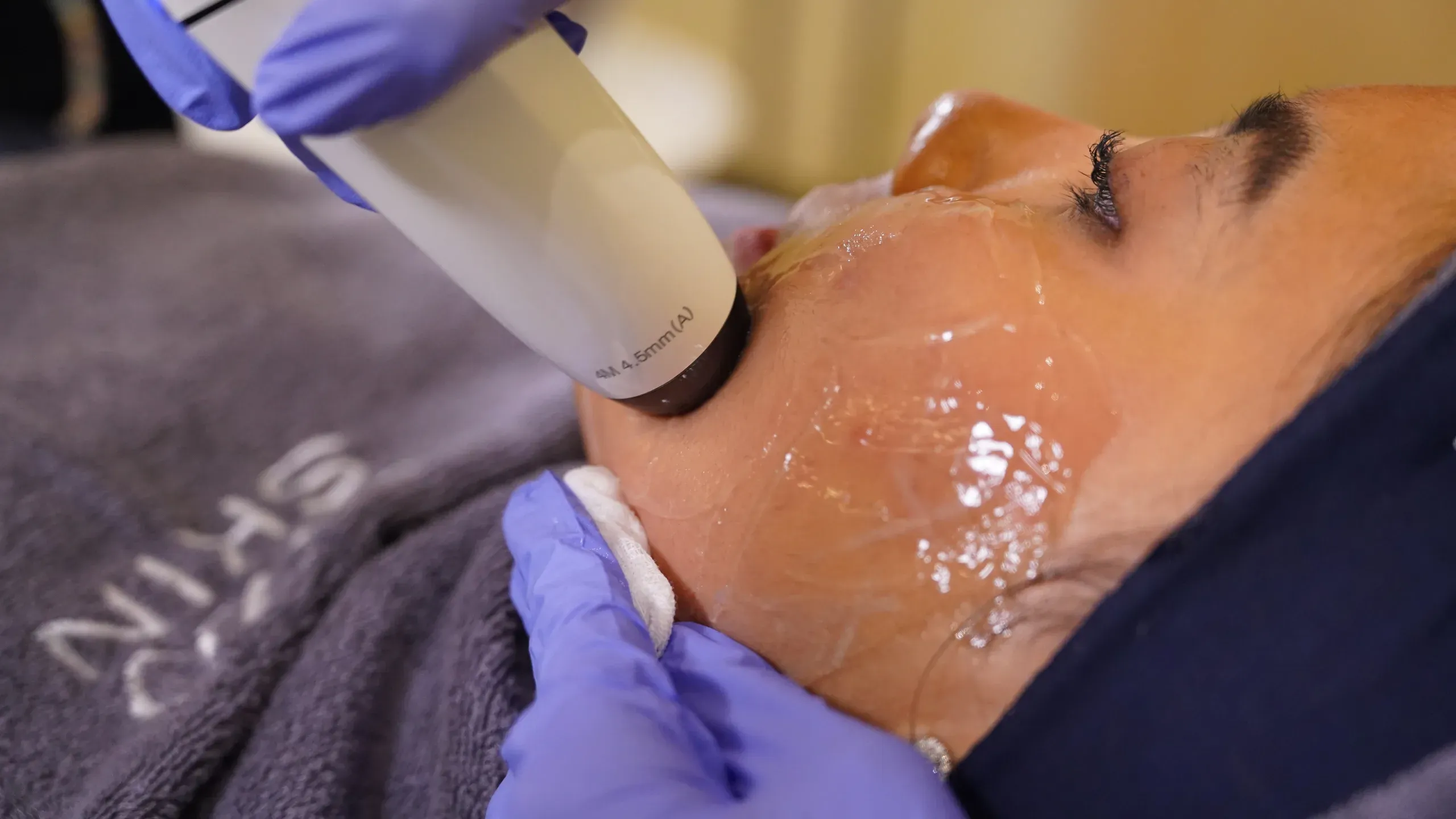 Hifu Treatment Sozo 6