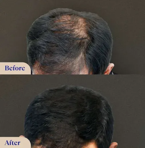 hair treatment before after
