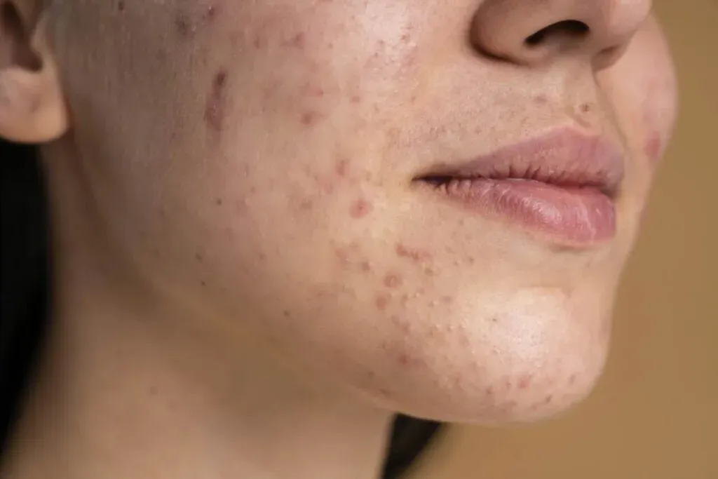 Bruntusan Bandel di Wajah? Atasi dengan Masker Alami ini!