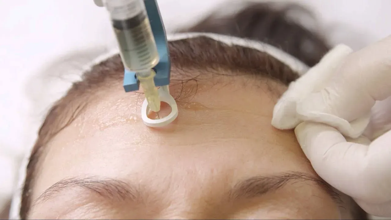 Mesotherapy di 2025: Tren Perawatan untuk Wajah Bebas Jerawat & Tirus