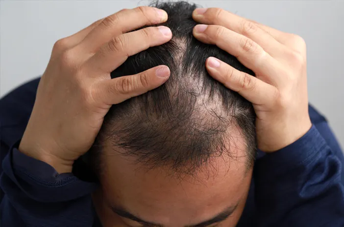 Stop Panik! Panduan Perawatan Rambut Tipis Khusus Pria