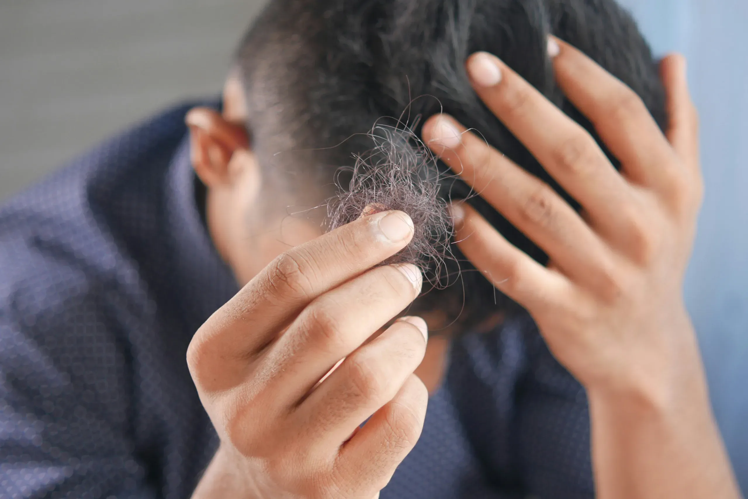 Rambut Rontok? Coba Minyak Alami Ini untuk Hasil Ampuh!