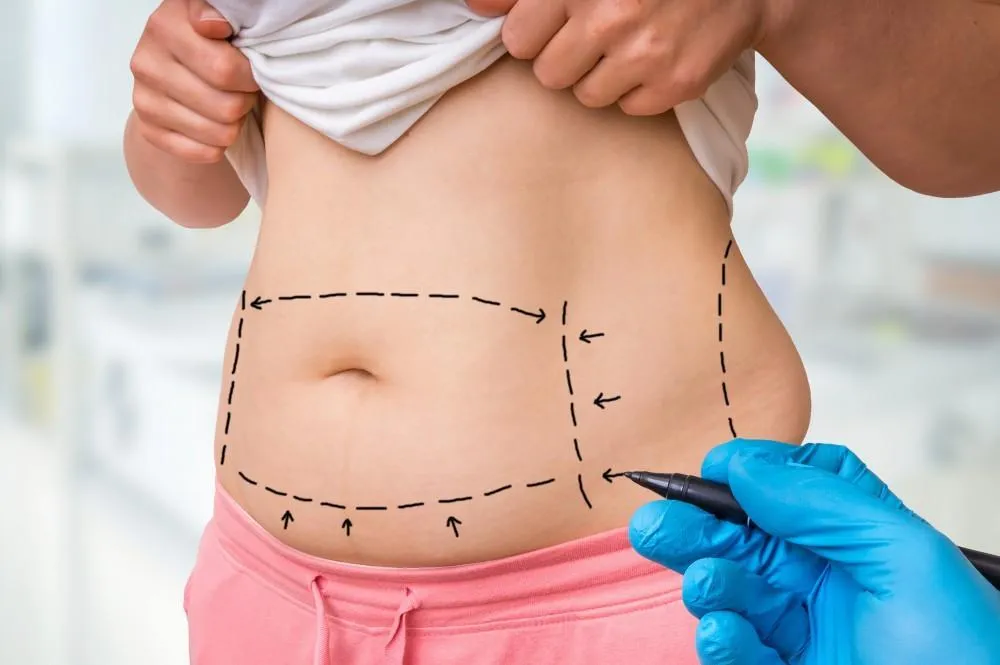 4 Metode Body Shaping Modern untuk Dapatkan Tubuh Ideal Tanpa Operasi