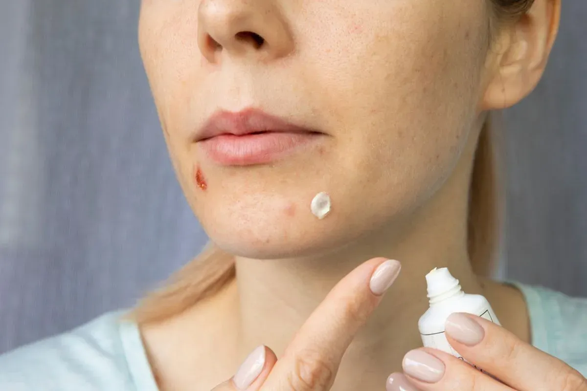 Punya Acne-Prone Skin? Ini Panduan Lengkap untuk Mengatasinya