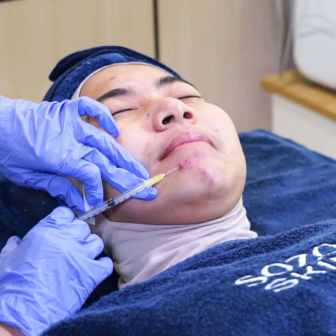 Acne Micro Botox Hydration