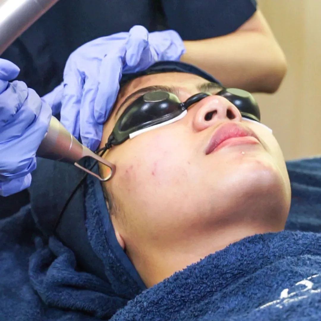 Acne Laser Facial