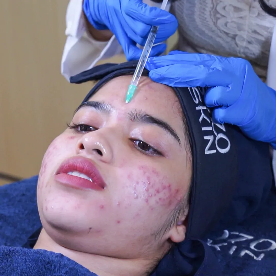 Acne Micro Botox Standard