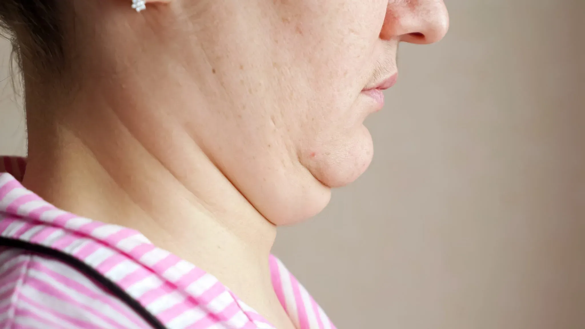 Hilangkan Double Chin Tanpa Operasi, Hasil Natural!