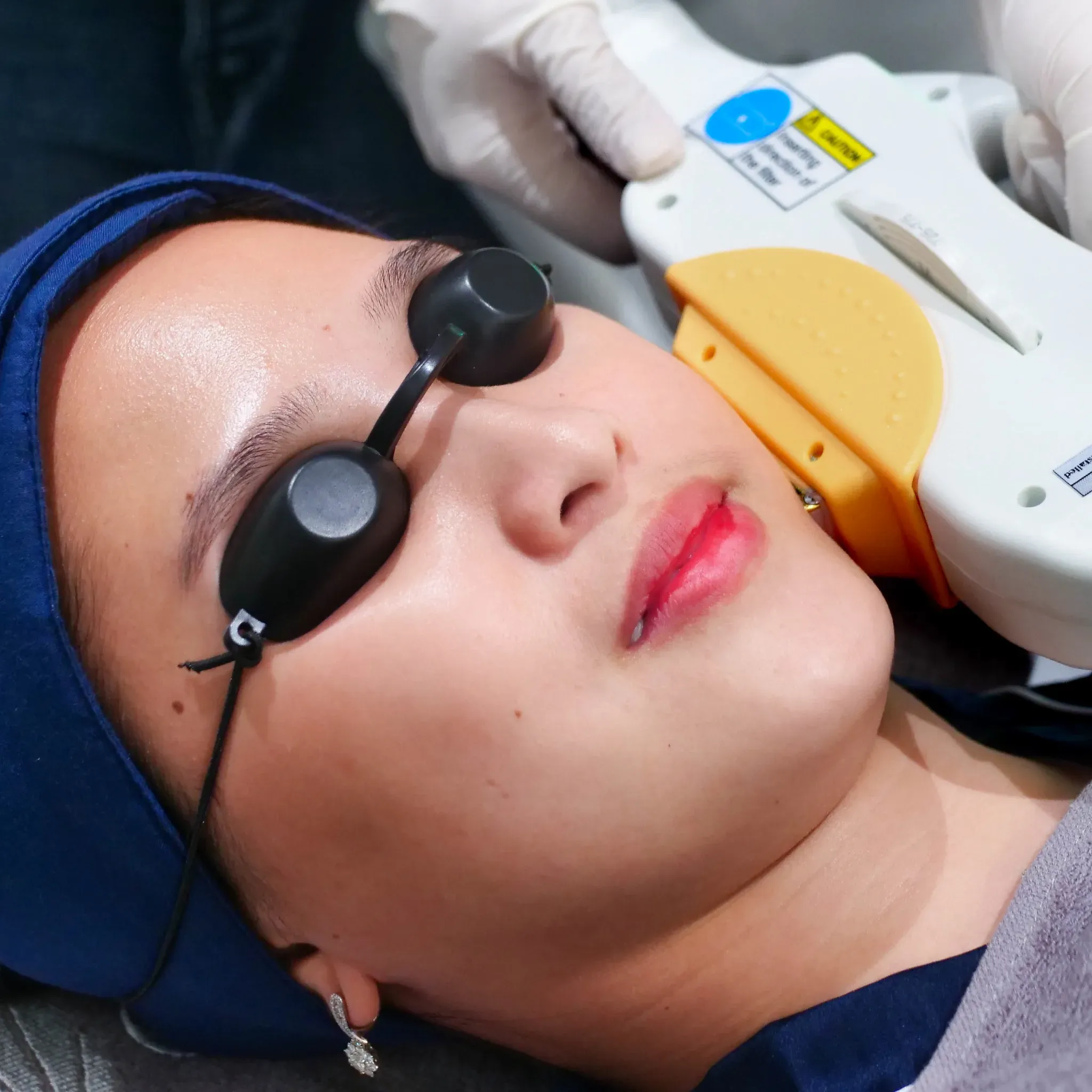 IPL Acne