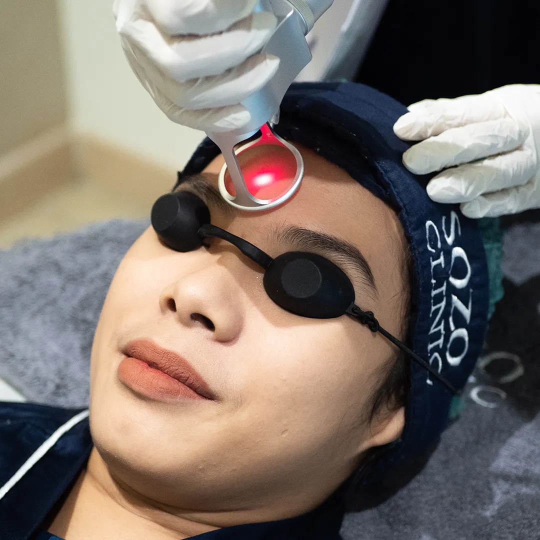 Laser CO2 Full Face