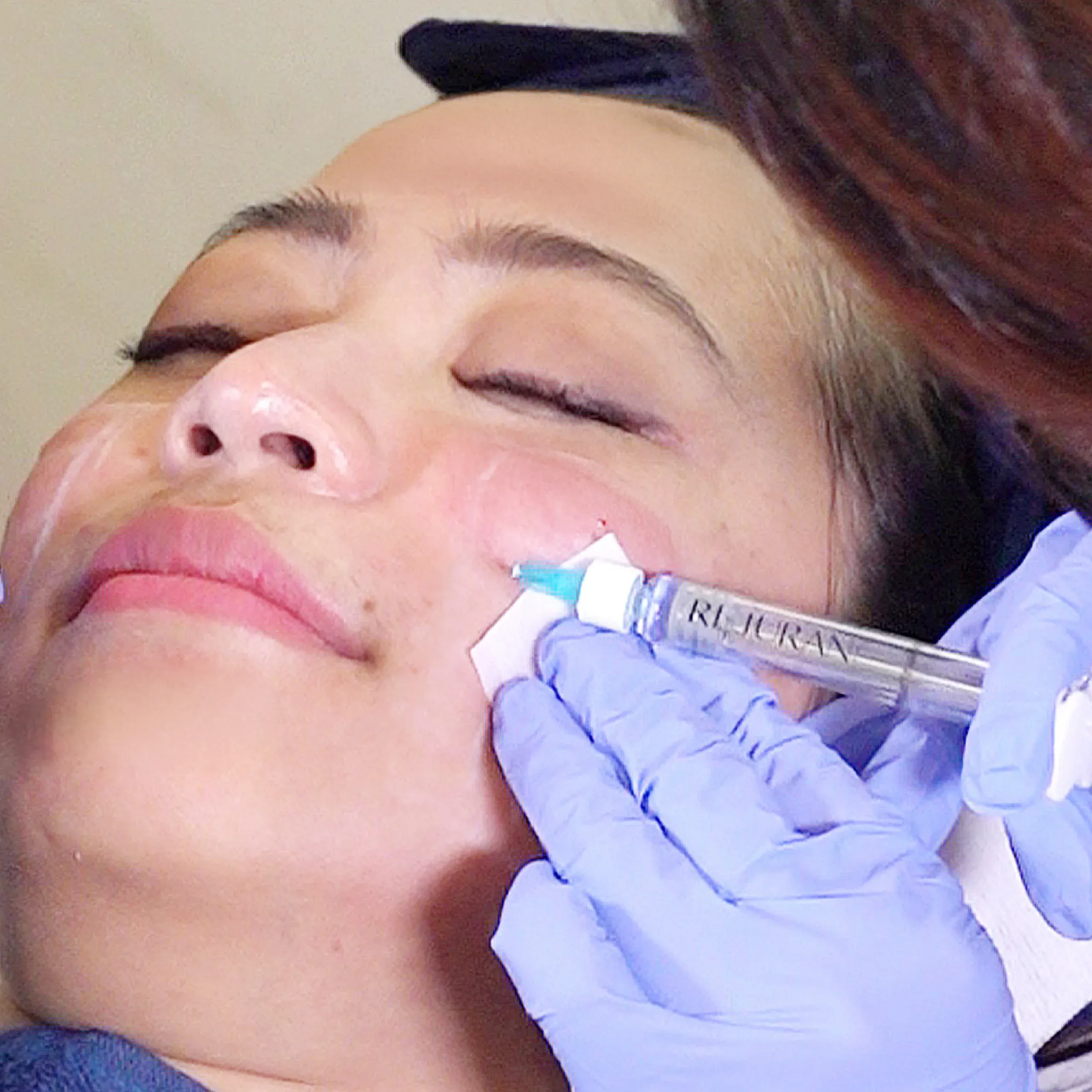 Scar Treatment