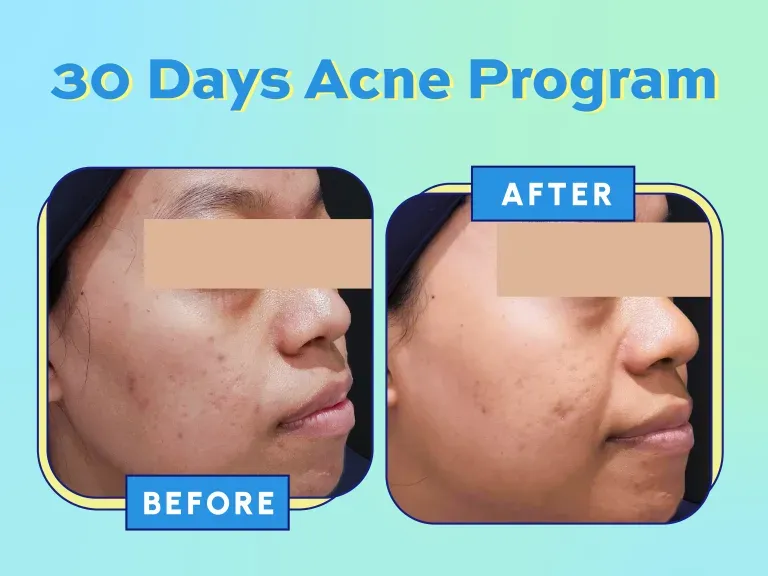 Before After 30 Days Acne Program