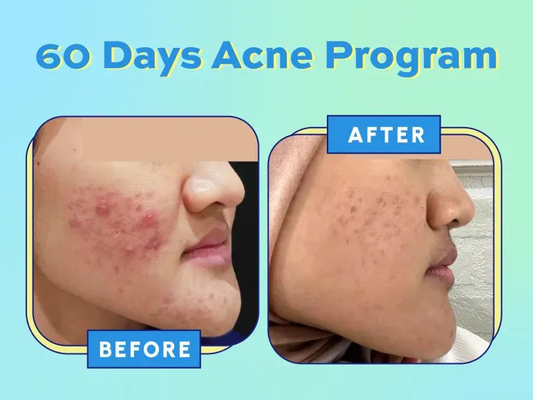 Before After 60 Days Acne Program