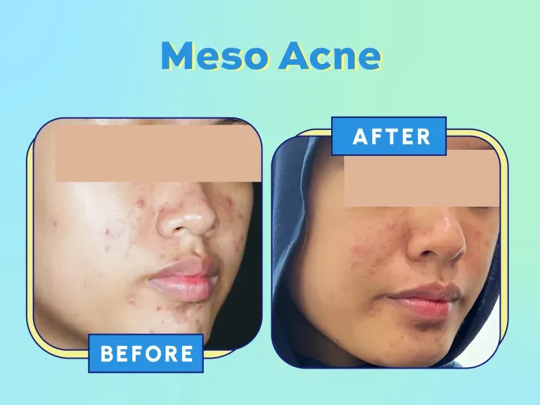 Before After Meso Acne