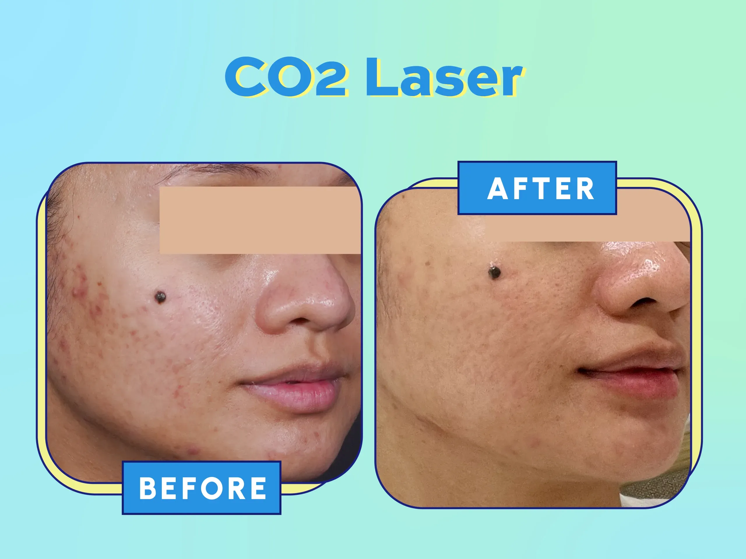 Hasil Sebelum dan Sesudah Laser CO2 SOZO 1