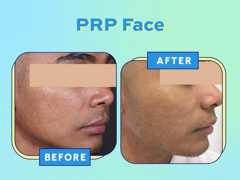 Before After Scar Treatment PRP