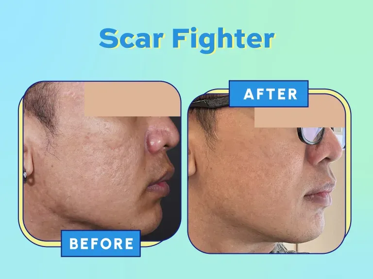 Before After Scar Treatment Laser