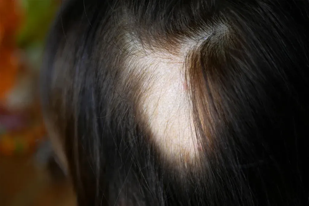 Apa Itu Autoimun Alopecia? Gejala, Penyebab & Solusinya